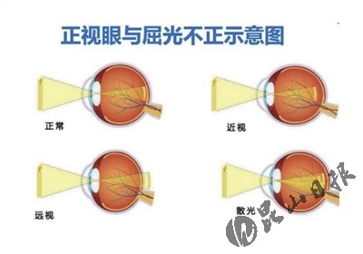什么是屈光不正|远视|散光|屈光不正_新浪新闻