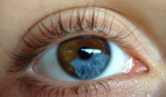 虹膜一小部分异色   ● 人眼颜色是光学现象的衍生 ●   人类瞳孔