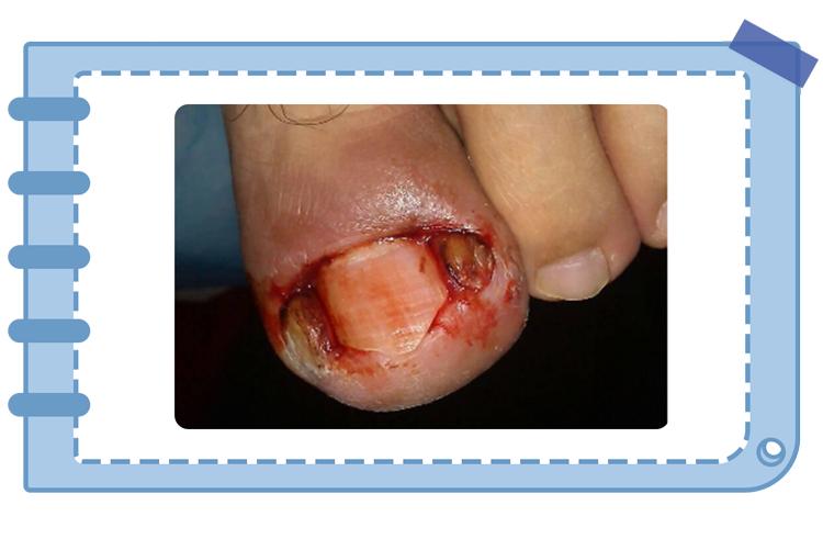 甲沟炎是什么原因啊 76ca-kquziik0002984.jpg