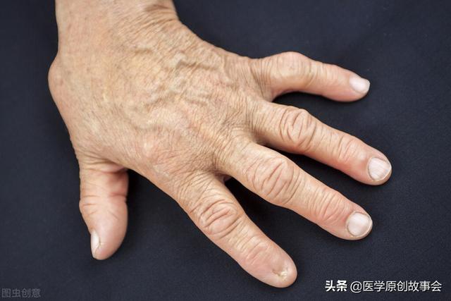 别把肺癌当成骨质增生,手指若有一个表现,可能是肺部在“求救”休闲区蓝鸢梦想 - Www.slyday.coM 别把肺癌当成骨质增生,手指若有一个表现,可能是肺部在“求救”休闲区蓝鸢梦想 - Www.slyday.coM