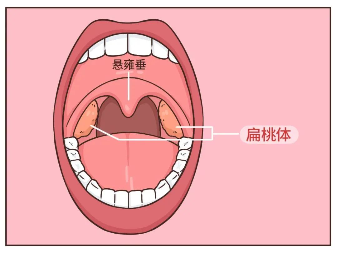 扁桃体炎|扁桃体|咽喉