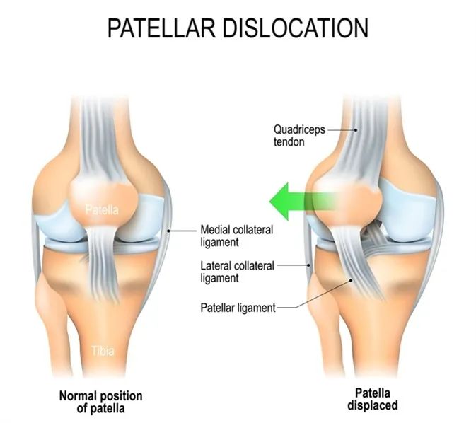 为什么膝盖骨左右移动:关于髌骨不稳和脱位