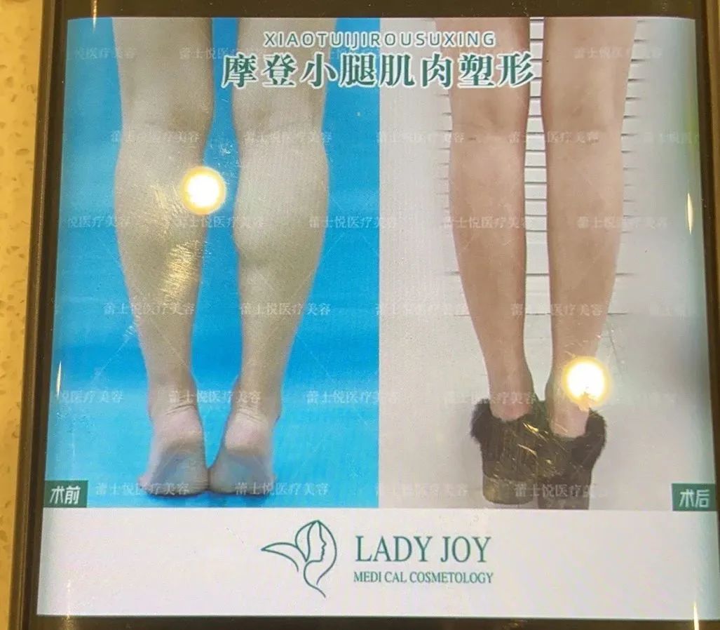  北京一家医美机构客服向新京报记者展示小腿肌肉阻断术案例图。受访者供图