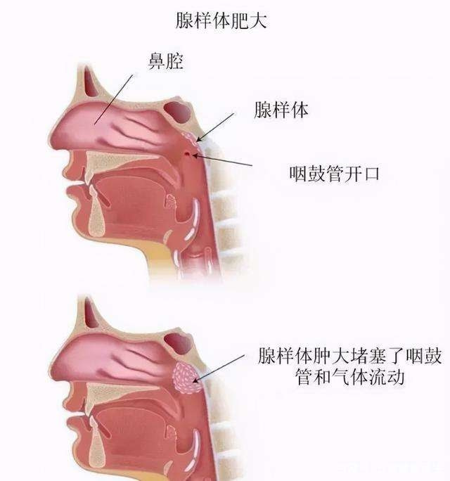 中医儿科李波孩子腺样体肥大有哪些原因和症状如何治疗护理