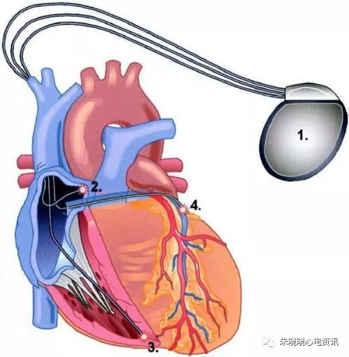 怎么装动态心电图必须掌握的心律失常49问_https://www.jmylbn.com_新闻资讯_第23张
