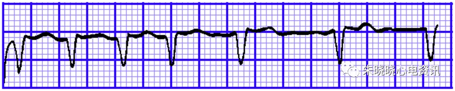 怎么装动态心电图必须掌握的心律失常49问_https://www.jmylbn.com_新闻资讯_第21张