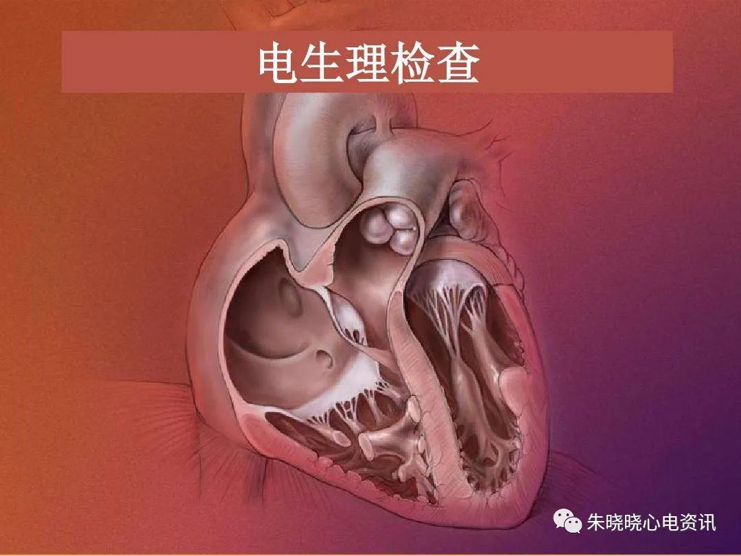怎么装动态心电图必须掌握的心律失常49问_https://www.jmylbn.com_新闻资讯_第17张