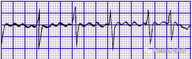 怎么装动态心电图必须掌握的心律失常49问_https://www.jmylbn.com_新闻资讯_第20张