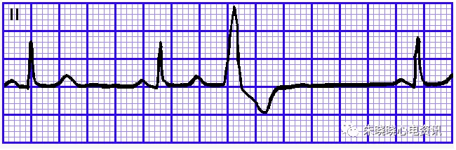 怎么装动态心电图必须掌握的心律失常49问_https://www.jmylbn.com_新闻资讯_第18张
