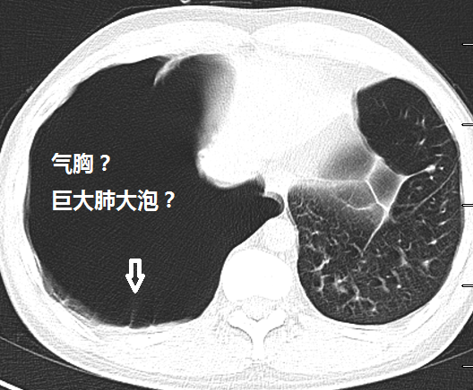 包裹性气胸or肺大泡这里有3个精彩病例