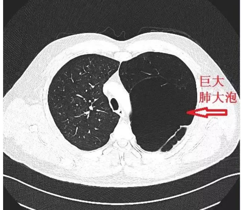 包裹性气胸 or 肺大泡?这里有3个精彩病例……|ct|胸部_新浪新闻
