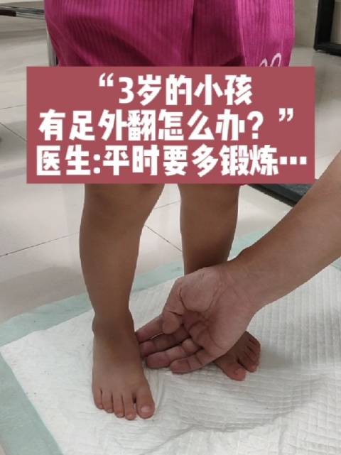 3岁的小孩有足外翻怎么办医生平时要多这样锻炼