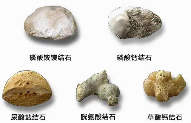 结石种类常见有草酸钙结石,尿酸盐结石,磷酸钙结石,磷酸铵镁结石,胱