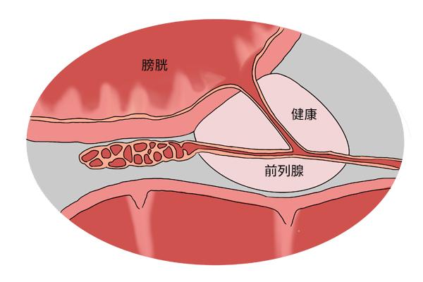 得了前列腺增生一定要手术吗医生提醒3个问题需要弄明白