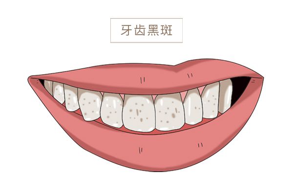 牙齿上有黑点是蛀牙吗牙结石带来3大危害该如何应对