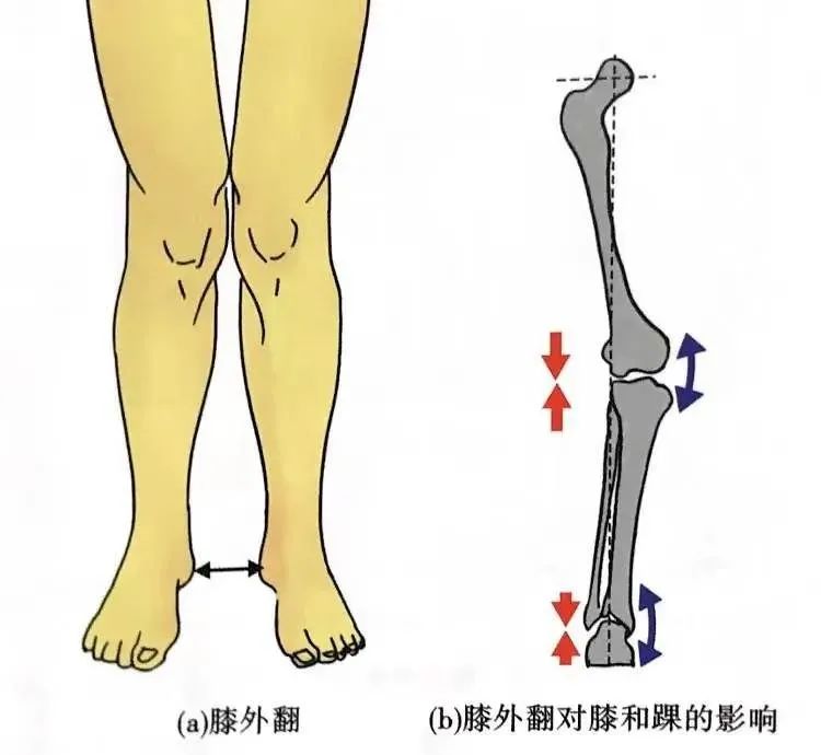 在膝外翻中,膝关节外侧间隙变窄,组织受压增加可能会导致退化病变(图9