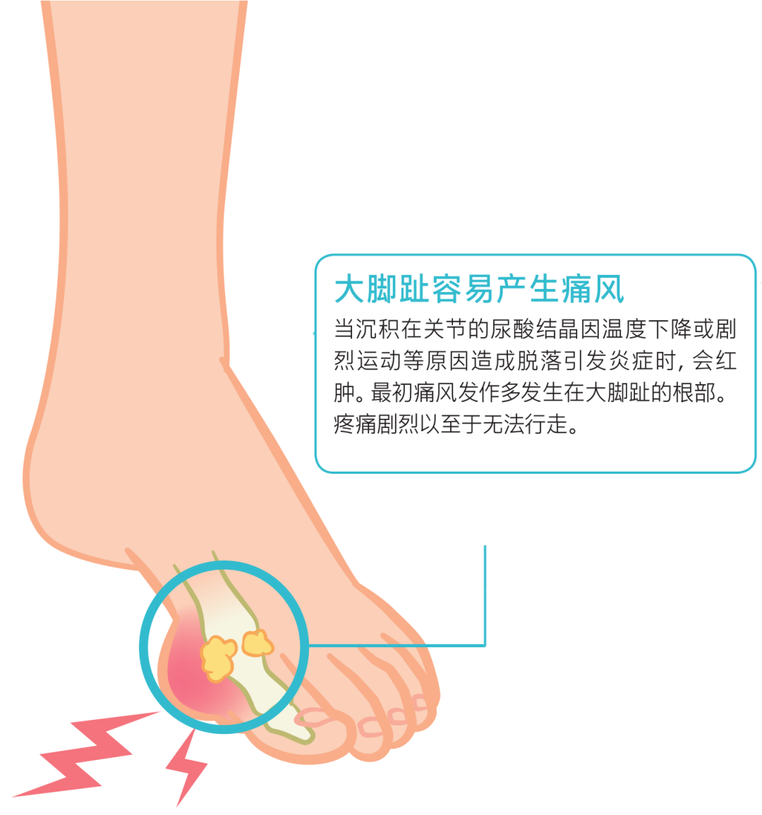 关节沉积,脱落时会产生疼痛,产生疼痛的位置,常见于脚趾根部的第一跖