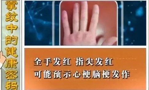 血管好不好 看手就知道!这5个地方长青筋太危险 可能突发心脑血管疾病!休闲区蓝鸢梦想 - Www.slyday.coM 血管好不好 看手就知道!这5个地方长青筋太危险 可能突发心脑血管疾病!休闲区蓝鸢梦想 - Www.slyday.coM