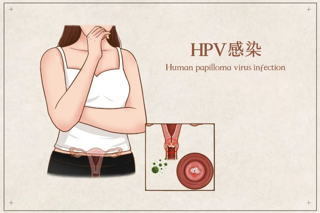 hpv初期照片 早期,尖锐初期照片早期 知己知彼百战不殆生殖道hpv感染