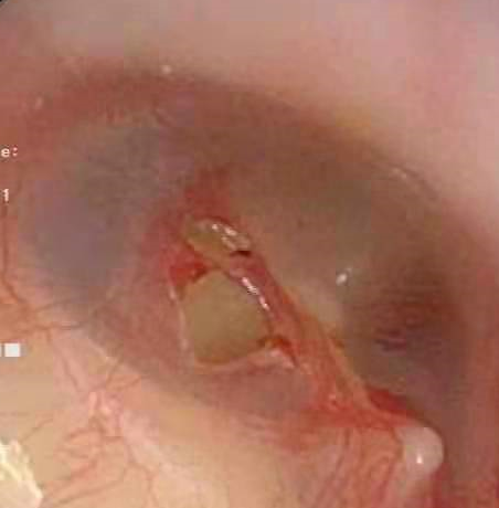 【聚焦】那些爱掏耳屎的人,后来都怎么样了?休闲区蓝鸢梦想 - Www.slyday.coM 【聚焦】那些爱掏耳屎的人,后来都怎么样了?休闲区蓝鸢梦想 - Www.slyday.coM