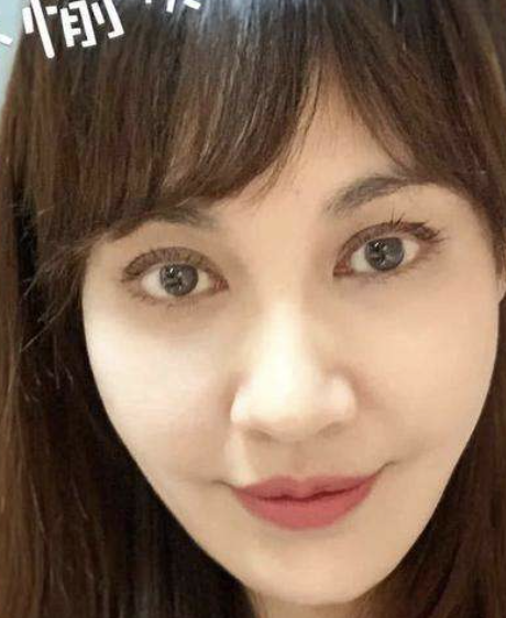 假体乱飞、笑比哭还难看!动脸后的“硅胶脸”才是最恐怖的 假体乱飞、笑比哭还难看!动脸后的“硅胶脸”才是最恐怖的