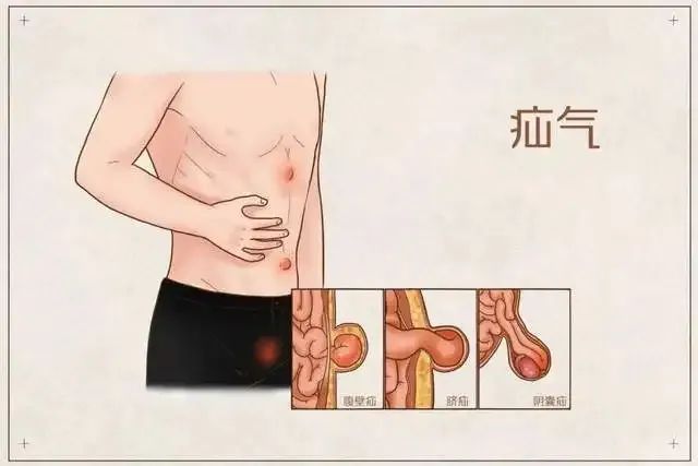 "疝气"常见部位:如腹股沟(大腿根部,小腹下方),腹壁,肚脐,阴囊等处