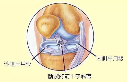 前交叉韧带会撕裂,是因为运动过程中膝关节处骨头出现快速过度的位移