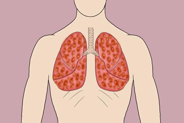 多数女性不抽烟,为啥肺癌仍“找上门”?预防肺癌,女性做好3点休闲区蓝鸢梦想 - Www.slyday.coM 多数女性不抽烟,为啥肺癌仍“找上门”?预防肺癌,女性做好3点休闲区蓝鸢梦想 - Www.slyday.coM