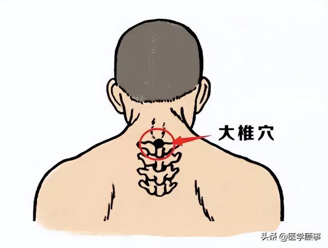 那么是什么原因使得我们的颈后大椎那个位置出现了一个明显的隆起呢?