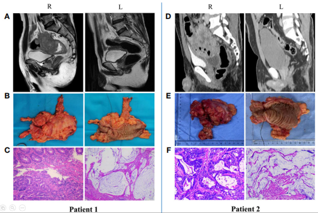 新辅助免疫治疗MSIH/dMMR局部晚期结直肠癌：新策略与新机遇微卫星抗癌免疫_新浪新闻