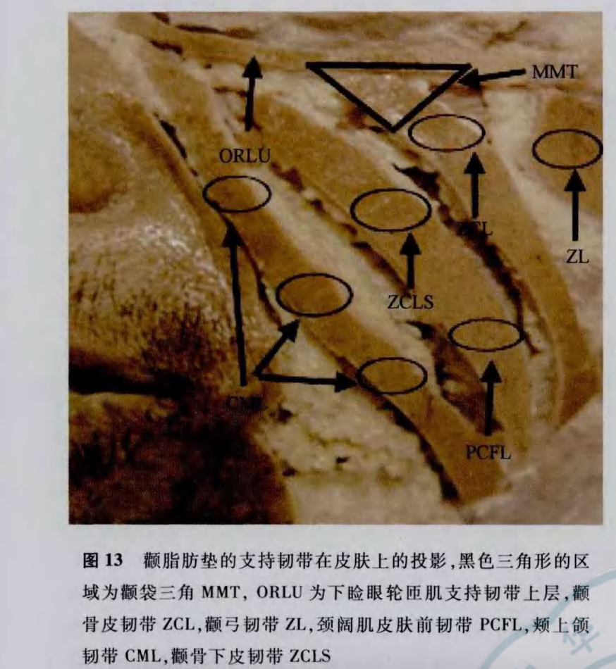 男人颧脂肪垫变样比女人更显老