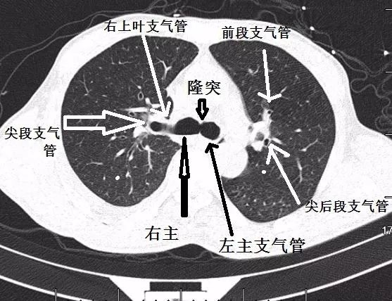 图8中叶,靠近心脏的是内侧段支气管,另外一支则是外侧段支气管.内