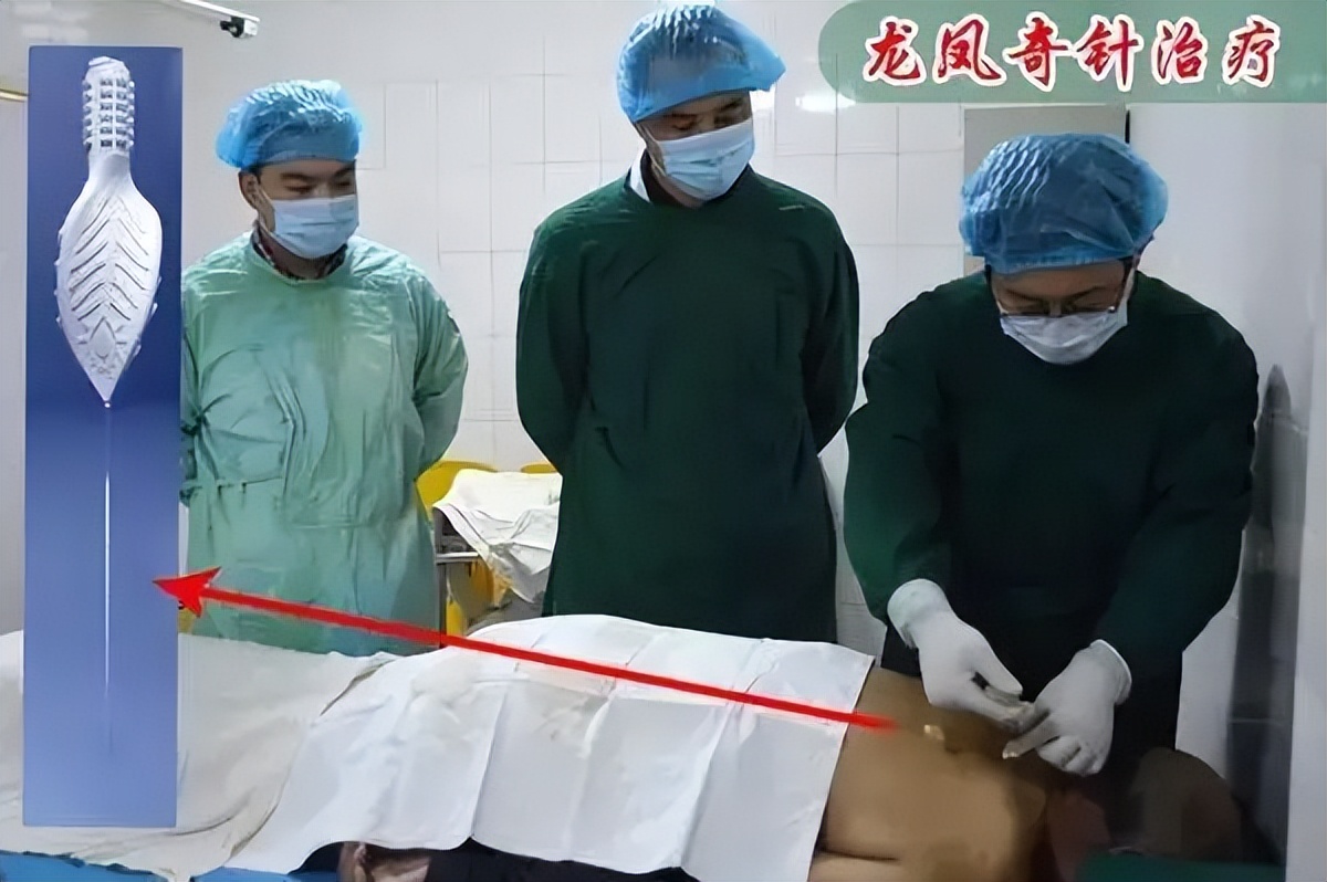 六脉神剑与王景新院长的龙凤奇针