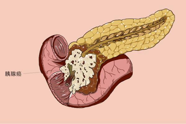 癌王胰腺癌确诊到死亡仅1年日常有3种表现是胰腺在求救