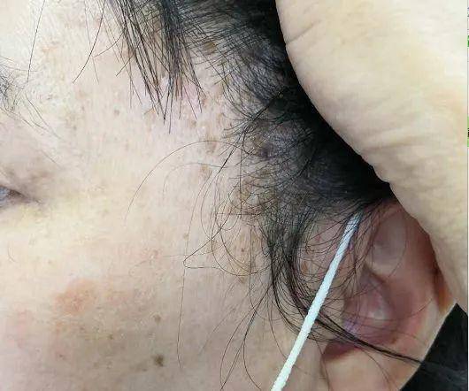 90后姑娘熬夜10年长出老年斑,原因竟然是这个!休闲区蓝鸢梦想 - Www.slyday.coM 90后姑娘熬夜10年长出老年斑,原因竟然是这个!休闲区蓝鸢梦想 - Www.slyday.coM