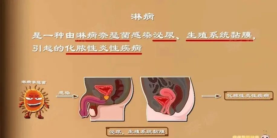 关于淋病你应该知道的都在这里点开了解