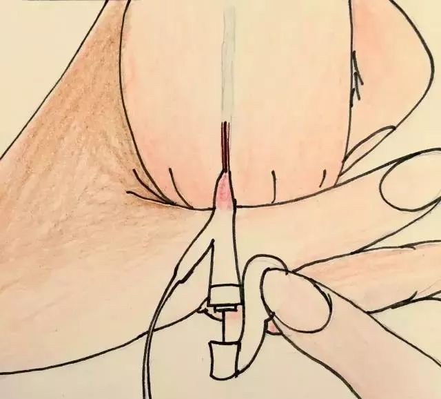 护士手绘新生儿扎针流程,这是一个被护士耽误了的画家吧?!休闲区蓝鸢梦想 - Www.slyday.coM 护士手绘新生儿扎针流程,这是一个被护士耽误了的画家吧?!休闲区蓝鸢梦想 - Www.slyday.coM