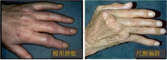 梭形肿胀及各种指间关节畸形赫伯登结节是远端指间关节的背侧软骨性