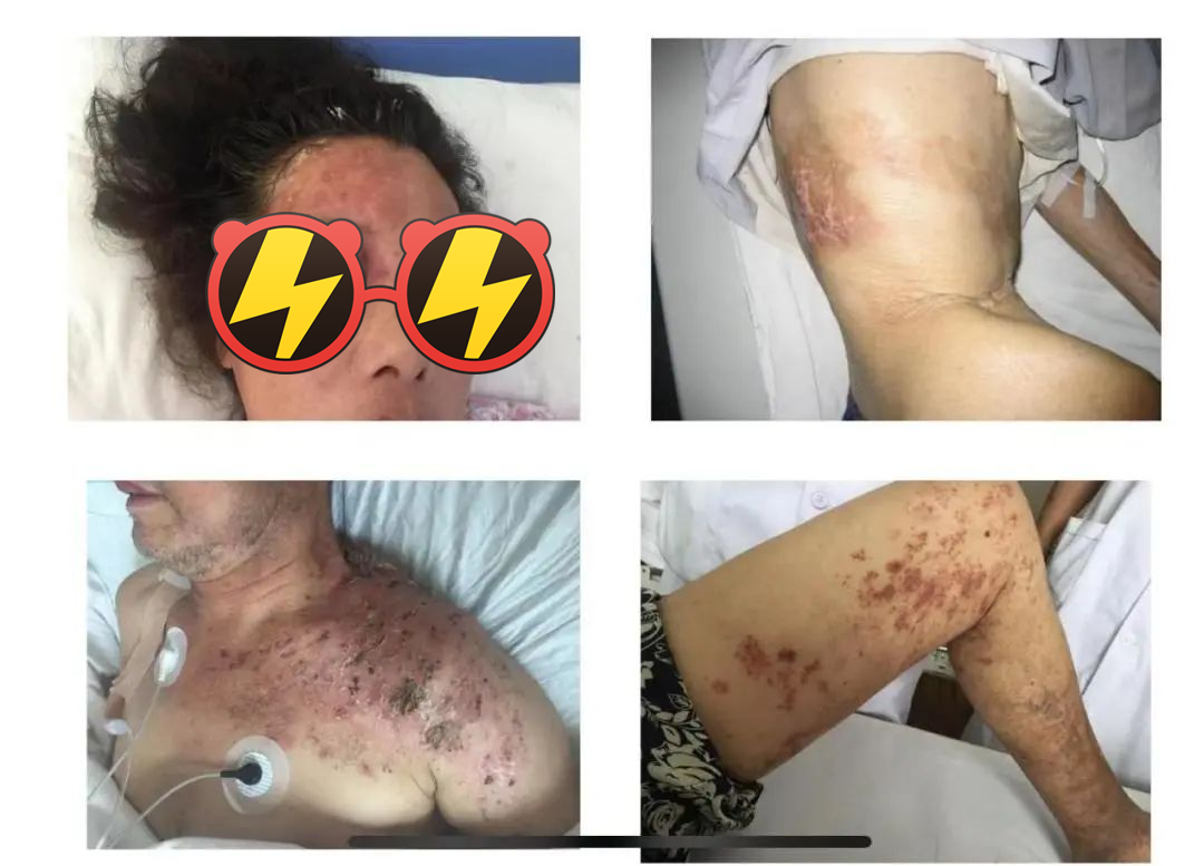 【提醒】疼起来要命的带状疱疹可以预防了!建议50岁及以上人群接种疫苗休闲区蓝鸢梦想 - Www.slyday.coM 【提醒】疼起来要命的带状疱疹可以预防了!建议50岁及以上人群接种疫苗休闲区蓝鸢梦想 - Www.slyday.coM