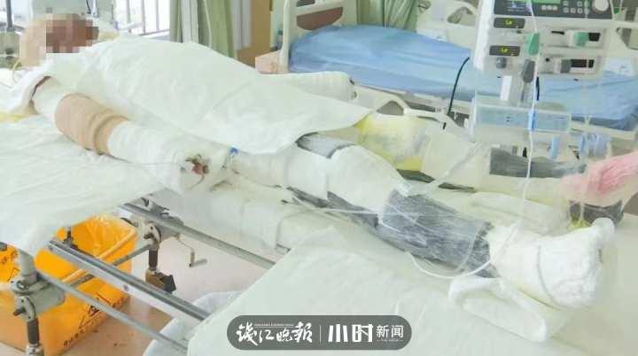 取下全部头皮,移植给重度烧伤的父亲!舟山一女子“割头皮救父”,医生说一周可长好休闲区蓝鸢梦想 - Www.slyday.coM 取下全部头皮,移植给重度烧伤的父亲!舟山一女子“割头皮救父”,医生说一周可长好休闲区蓝鸢梦想 - Www.slyday.coM