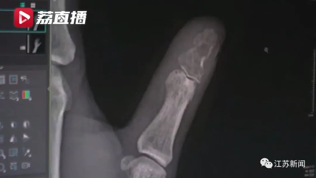 男子被狗咬伤手指,1个月后指骨竟被“吃空”!休闲区蓝鸢梦想 - Www.slyday.coM 男子被狗咬伤手指,1个月后指骨竟被“吃空”!休闲区蓝鸢梦想 - Www.slyday.coM