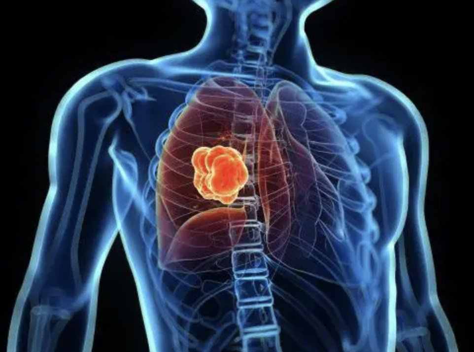 3姐妹不抽烟接连被查出肺癌,医生:属于遗传易感性,一定要重视肺癌筛查休闲区蓝鸢梦想 - Www.slyday.coM 3姐妹不抽烟接连被查出肺癌,医生:属于遗传易感性,一定要重视肺癌筛查休闲区蓝鸢梦想 - Www.slyday.coM