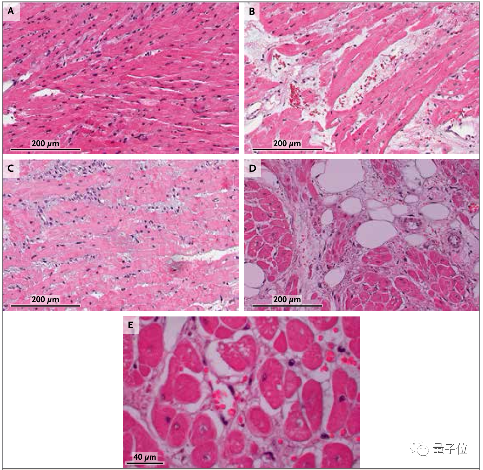 首例猪心移植细节全面披露:患者体内发现人类疱疹病毒,死后心脏重量翻倍,心肌细胞纤维化丨团队最新论文休闲区蓝鸢梦想 - Www.slyday.coM 首例猪心移植细节全面披露:患者体内发现人类疱疹病毒,死后心脏重量翻倍,心肌细胞纤维化丨团队最新论文休闲区蓝鸢梦想 - Www.slyday.coM