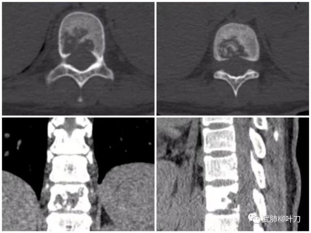 姑娘感觉腰痛 仅过一个月就瘫了竟是毛毛虫般的病菌钻进脊髓医生:这病要早治 再晚就永远站不起来了休闲区蓝鸢梦想 - Www.slyday.coM 姑娘感觉腰痛 仅过一个月就瘫了竟是毛毛虫般的病菌钻进脊髓医生:这病要早治 再晚就永远站不起来了休闲区蓝鸢梦想 - Www.slyday.coM