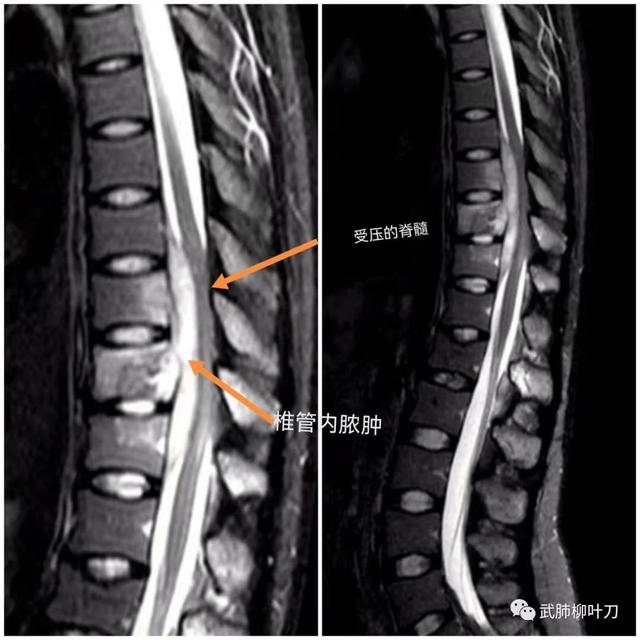 姑娘感觉腰痛 仅过一个月就瘫了竟是毛毛虫般的病菌钻进脊髓医生:这病要早治 再晚就永远站不起来了休闲区蓝鸢梦想 - Www.slyday.coM 姑娘感觉腰痛 仅过一个月就瘫了竟是毛毛虫般的病菌钻进脊髓医生:这病要早治 再晚就永远站不起来了休闲区蓝鸢梦想 - Www.slyday.coM