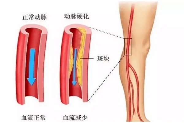 腿梗是个什么“梗”?出现这个症状要当心!休闲区蓝鸢梦想 - Www.slyday.coM 腿梗是个什么“梗”?出现这个症状要当心!休闲区蓝鸢梦想 - Www.slyday.coM