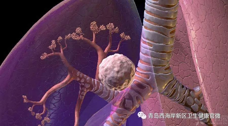 技术上水平西海岸新区人民医院巧解气管险窒息难题!(图3) 技术上水平西海岸新区人民医院巧解气管险窒息难题!(图3)