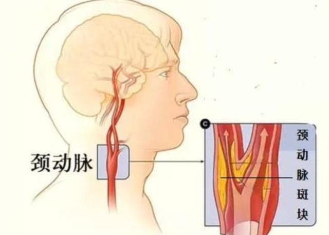 男子颈动脉内被捉出一条小虫如何预防这个温柔杀手