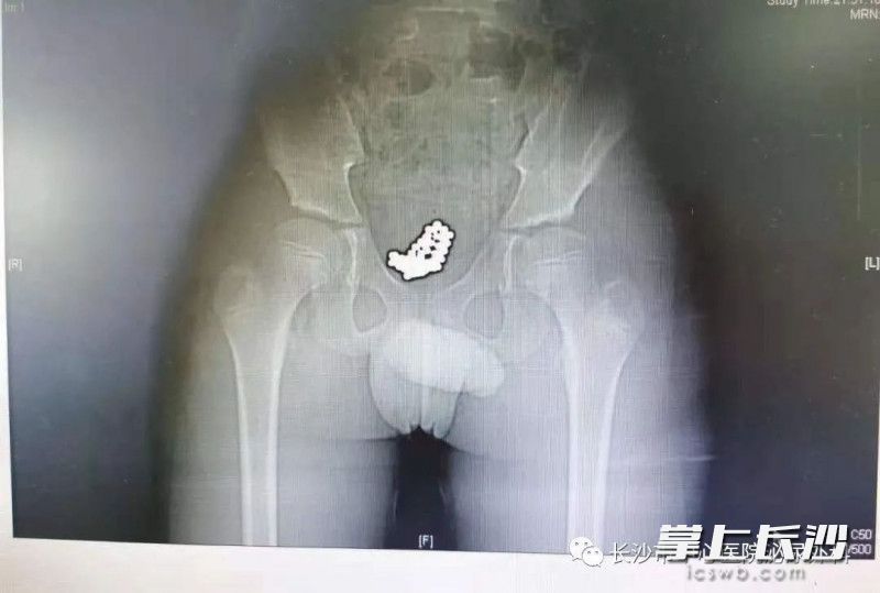 74颗磁力珠!长沙10岁男孩把它们塞进了……休闲区蓝鸢梦想 - Www.slyday.coM 74颗磁力珠!长沙10岁男孩把它们塞进了……休闲区蓝鸢梦想 - Www.slyday.coM