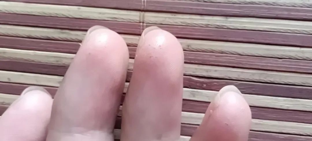 因长期通过指尖采血测血糖,患者手上布满了针孔。受访者供图